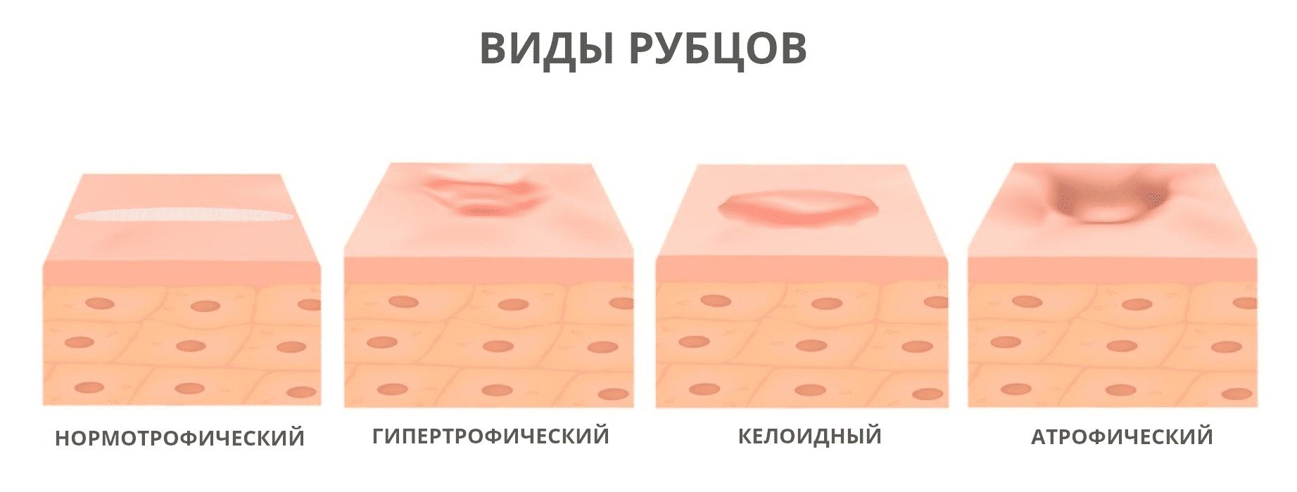 Виды рубцов